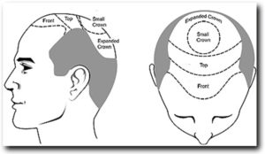 Hair transplant donor areas