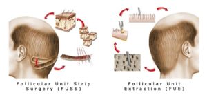 FUSS vs FUE hair transplant
